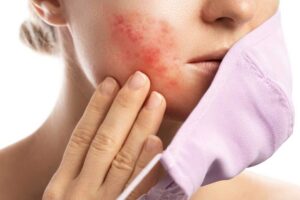 Read more about the article How to treat Acne the fast and easy way